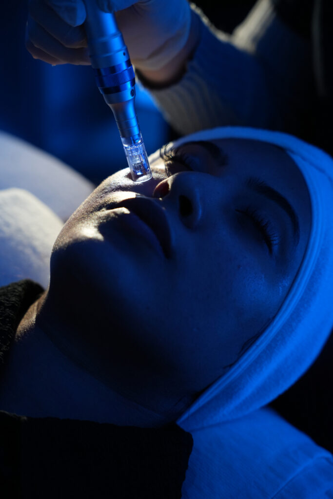 Microneedling  (Face or Scalp)