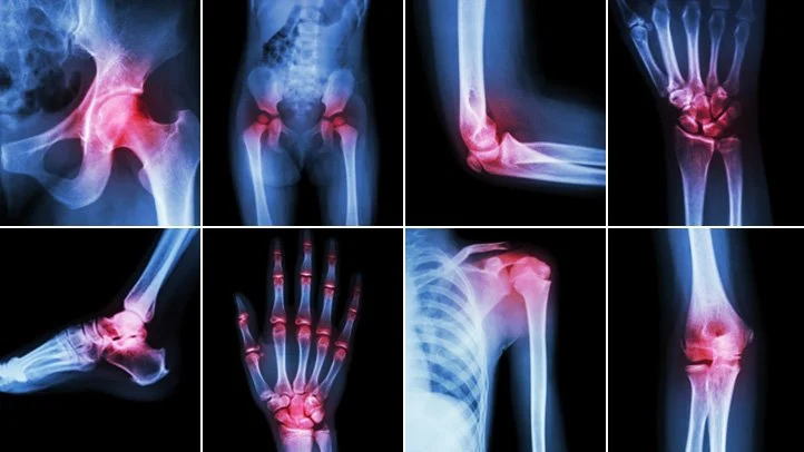 The ABCD’s of Arthritis